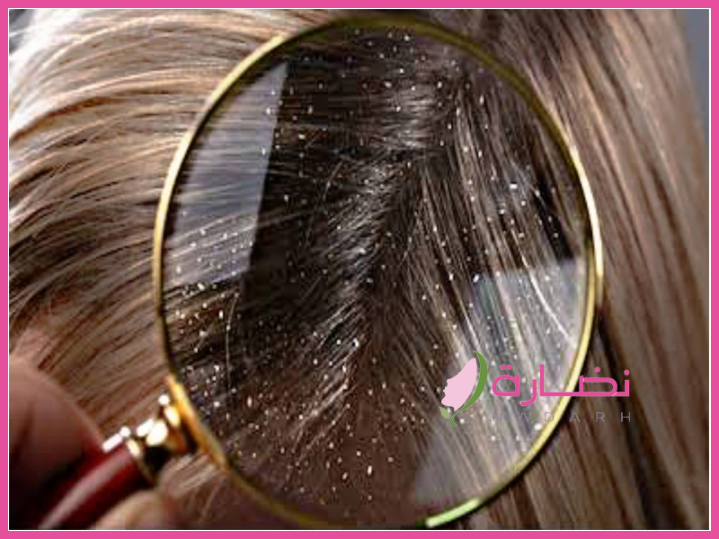 تعرفي معنا على أهم انواع قشرة الشعر بالصور ... وطرق علاجها !!