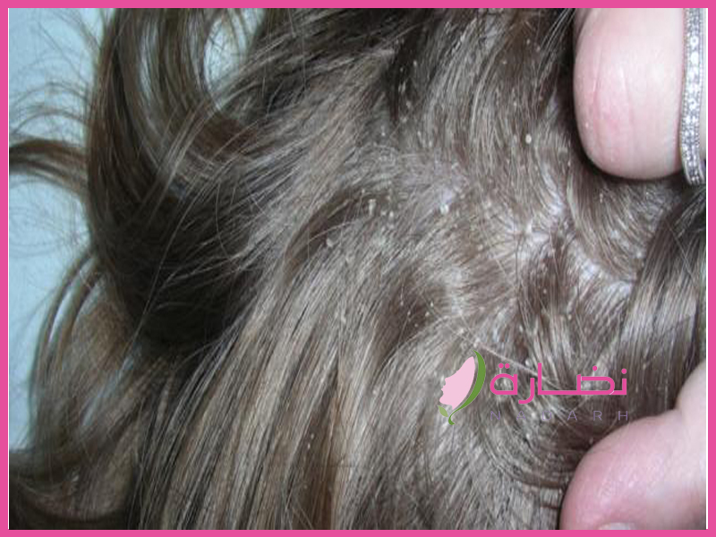تعرفى على أهم اسباب قشرة الشعر وكيفية علاجها