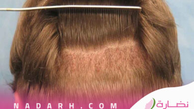 زراعة الشعر في الرياض