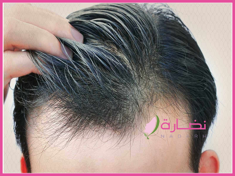 زراعة الشعر في السعودية